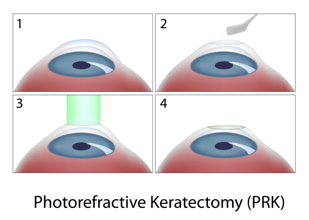 Illustration showing the stages of LASIK surgery